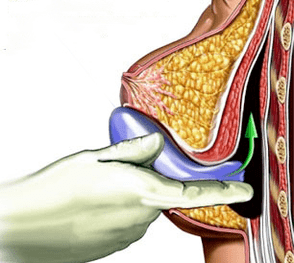implantácia na zväčšenie prsníkov