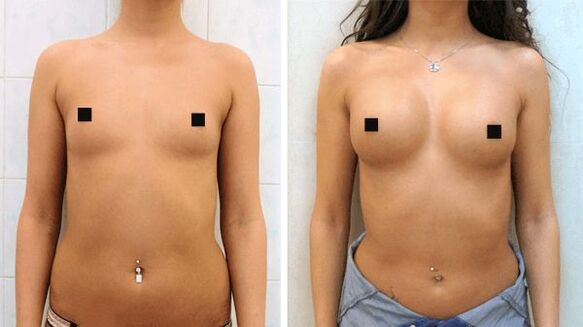 fotografie pred a po chirurgickom zväčšení prsníkov