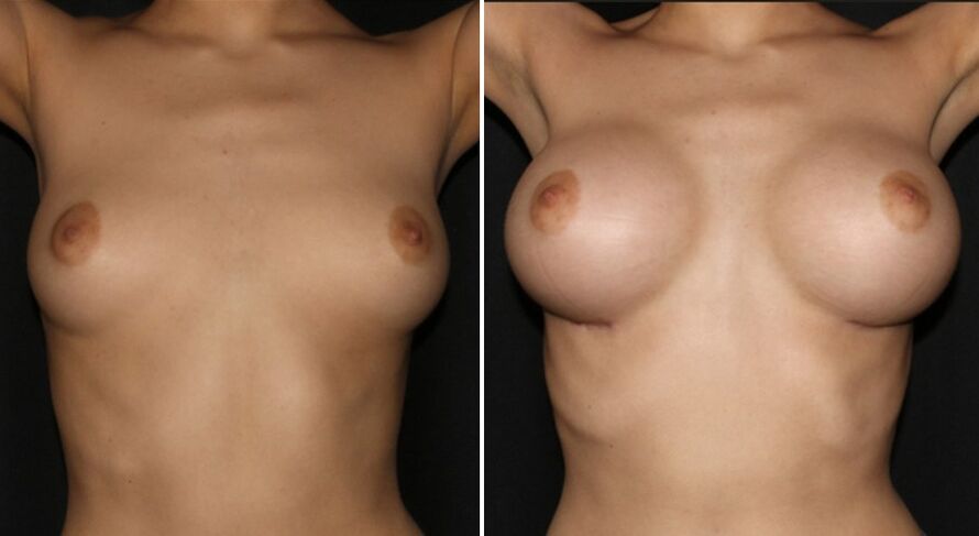 Pred a po operácii na zväčšenie prsníkov
